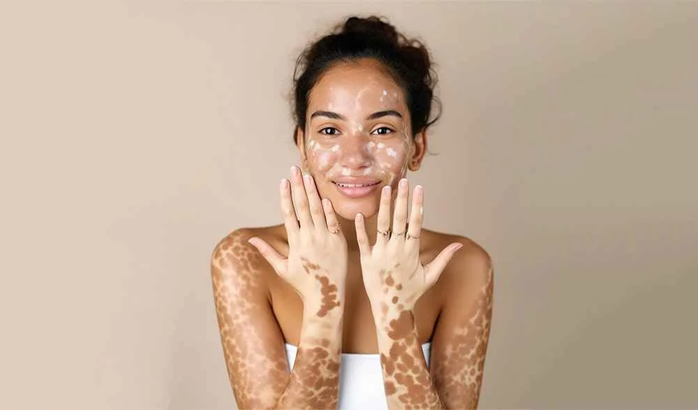 Vitiligo
