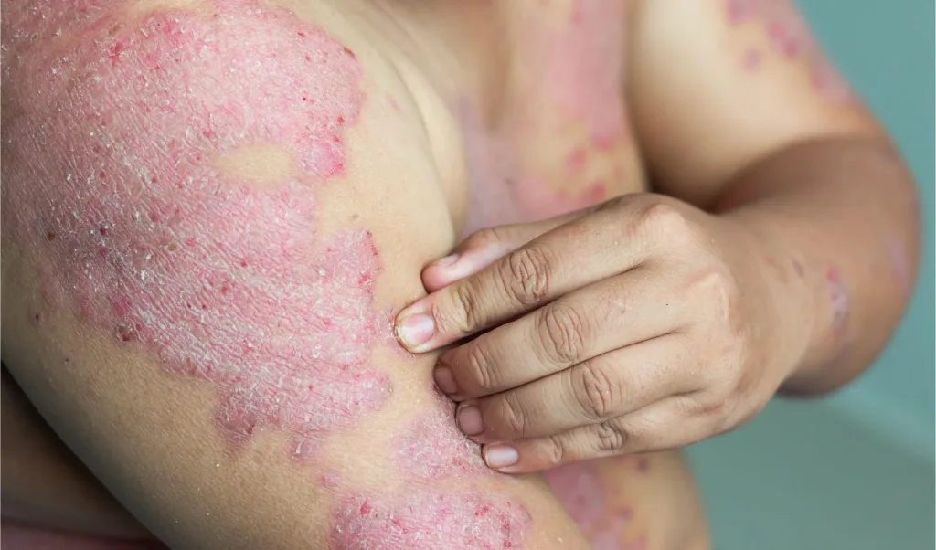 Eczema