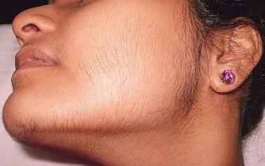 Hair reduction