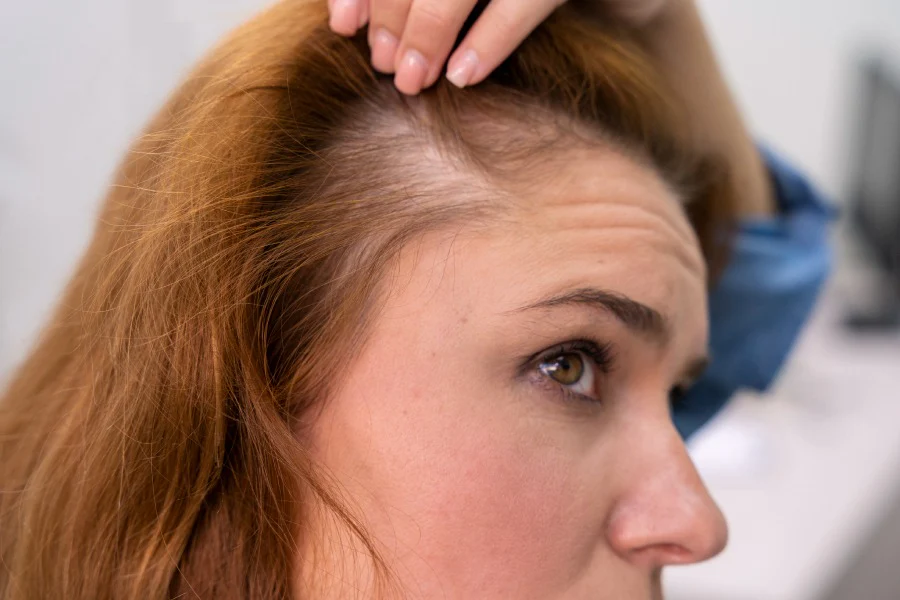 First_Signs_of_Hair_Thinning_in_Women