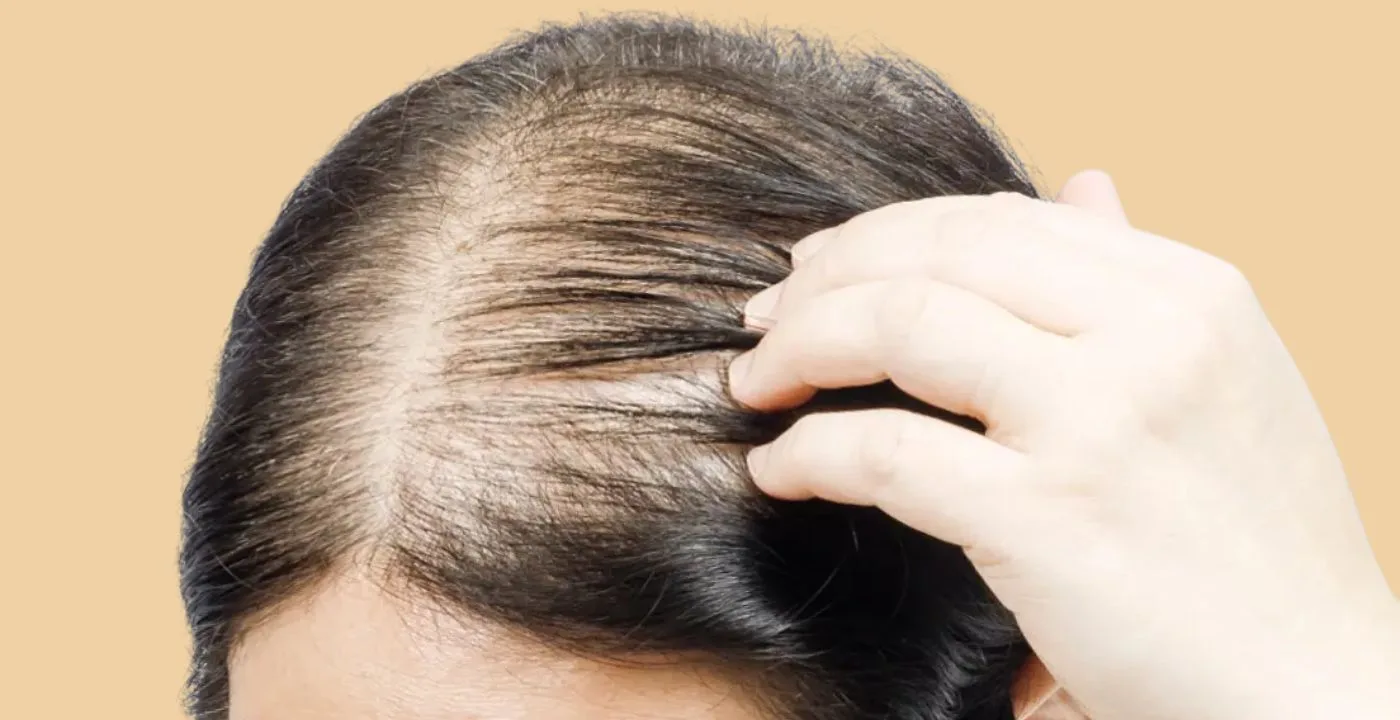 reason-for-hair-thinning-and-loss-1669787237662